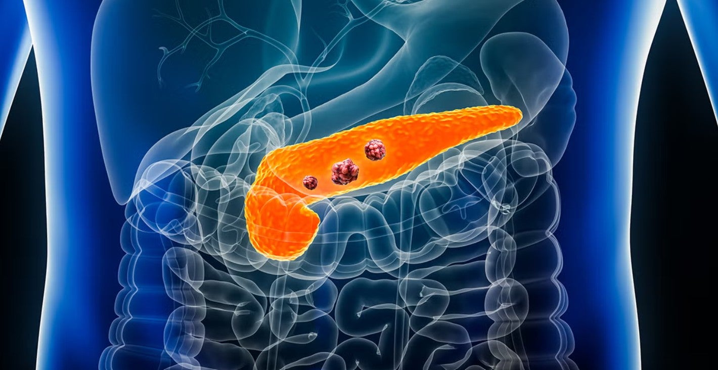 Medical illustration showing an anatomical x-ray view of a human torso. The surrounding digestive organs and skeletal structure are rendered in semi-transparent blue and white outlines. The pancreas is highlighted in bright textured orange, with three small, reddish-brown tumorous nodules depicted on its surface.